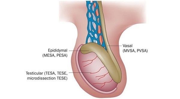 Surgical Sperm Retrieval Technique for Azoospermia (TESA, PESA)